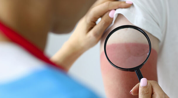 Eine Ärztin oder medizinische Mitarbeiterin bestimmt mit einer Lupe den Grad des Sonnenbrands am Oberarm eines Patienten